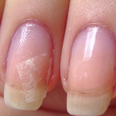 Восстановление сломанного ногтя